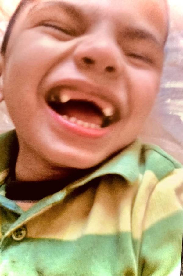 A young child wearing a green striped shirt is laughing with their mouth open wide, showing missing and crooked teeth.
