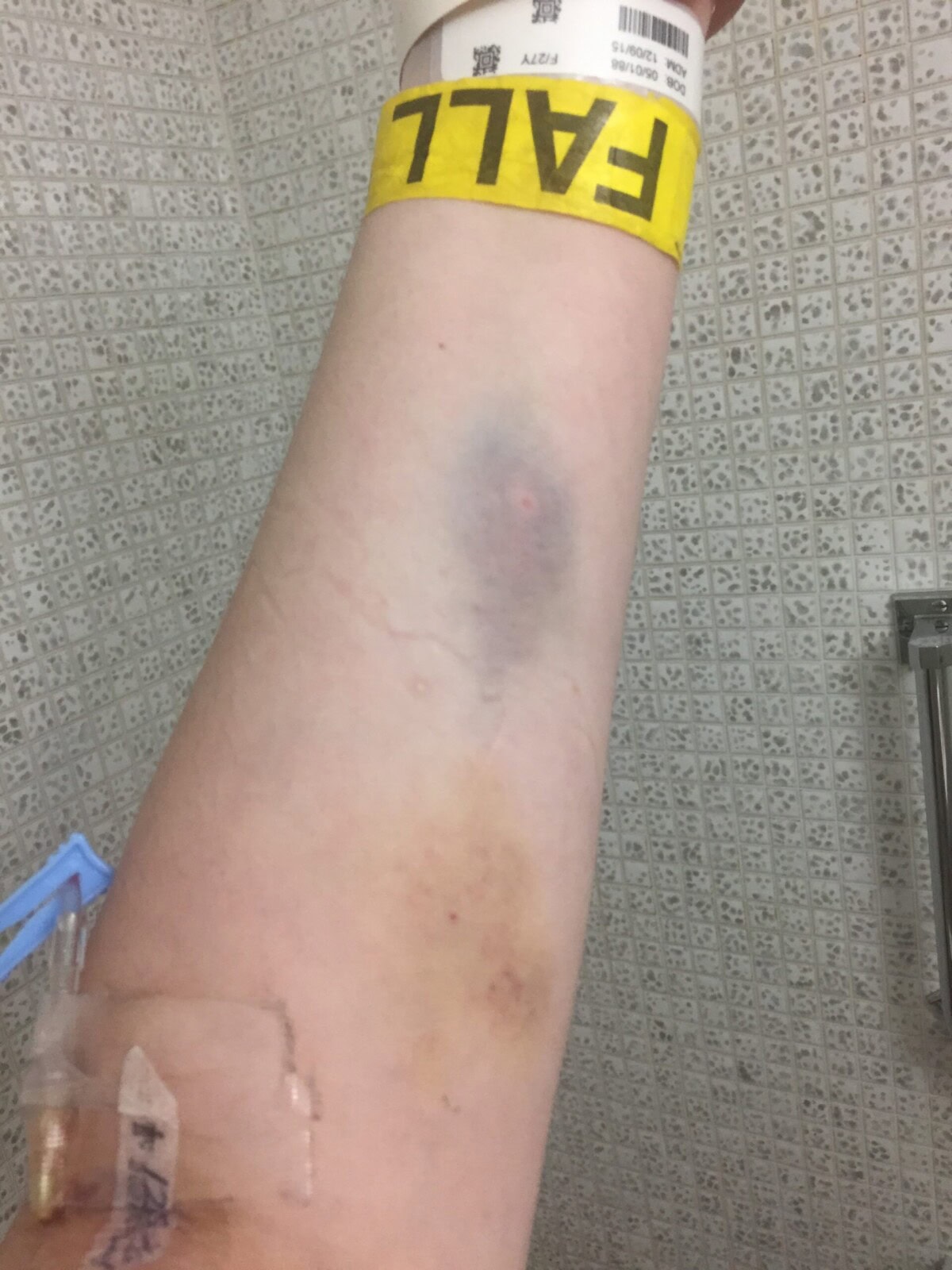 A forearm with a hospital wristband labeled "FALL," visible bruising, and a taped IV line against a tiled wall background.