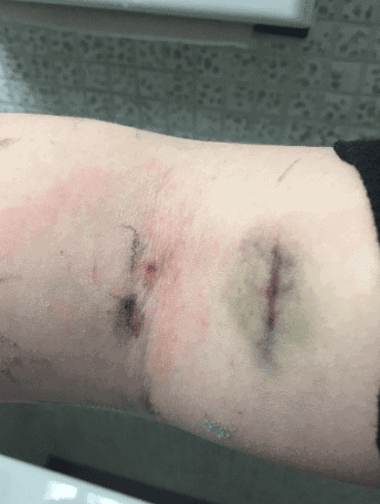 A close-up of a person's wrist showing two horizontal scars with surrounding redness and mild bruising.